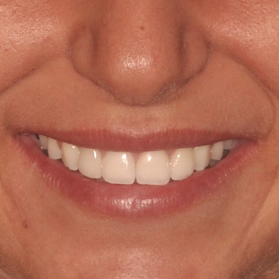 Smile Example One