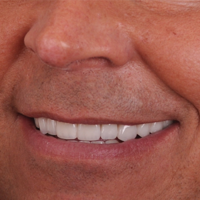 Smile Example Two