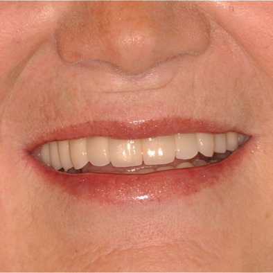 Smile Example Three